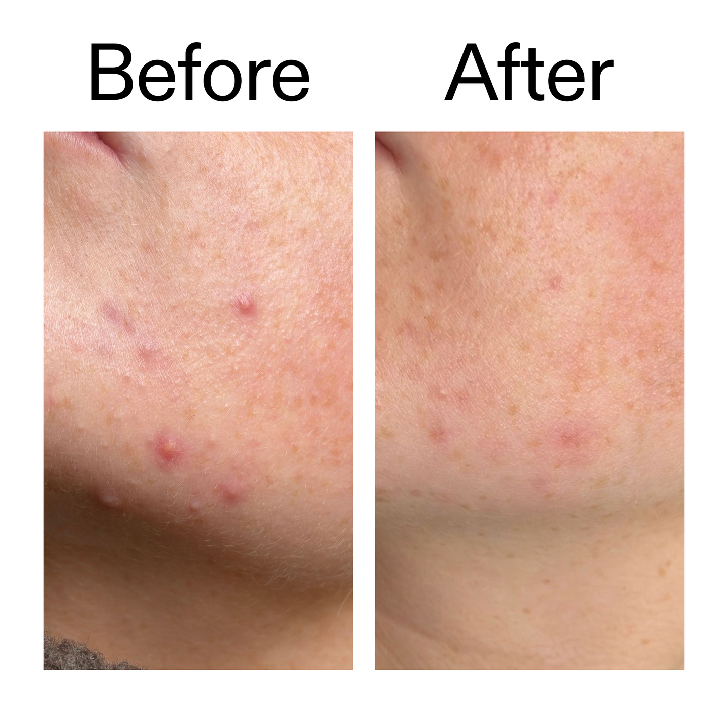 10-azelaic-acid-serum-for-redness-relief-j8 B_A_1_PPAGE.png