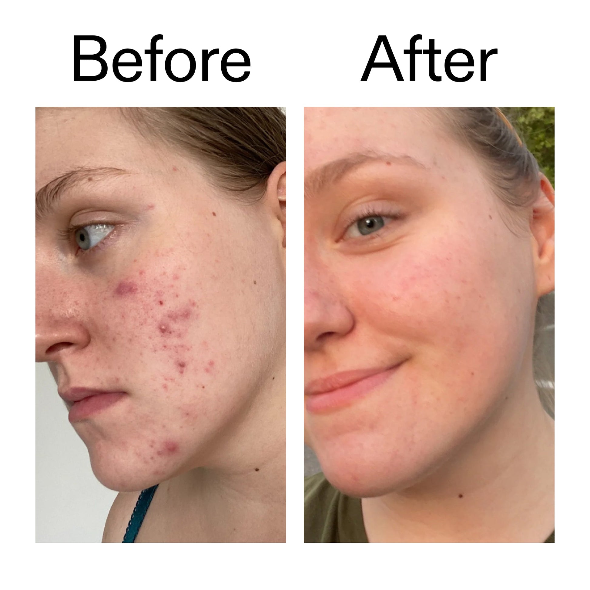 15-vitamin-c-egf-serum-o2 15_Vitamin_C_EGF_Serum_Before_After_2000x2000_fb9f598a-3386-40c8-8143-36f9d7a17ec8.jpg