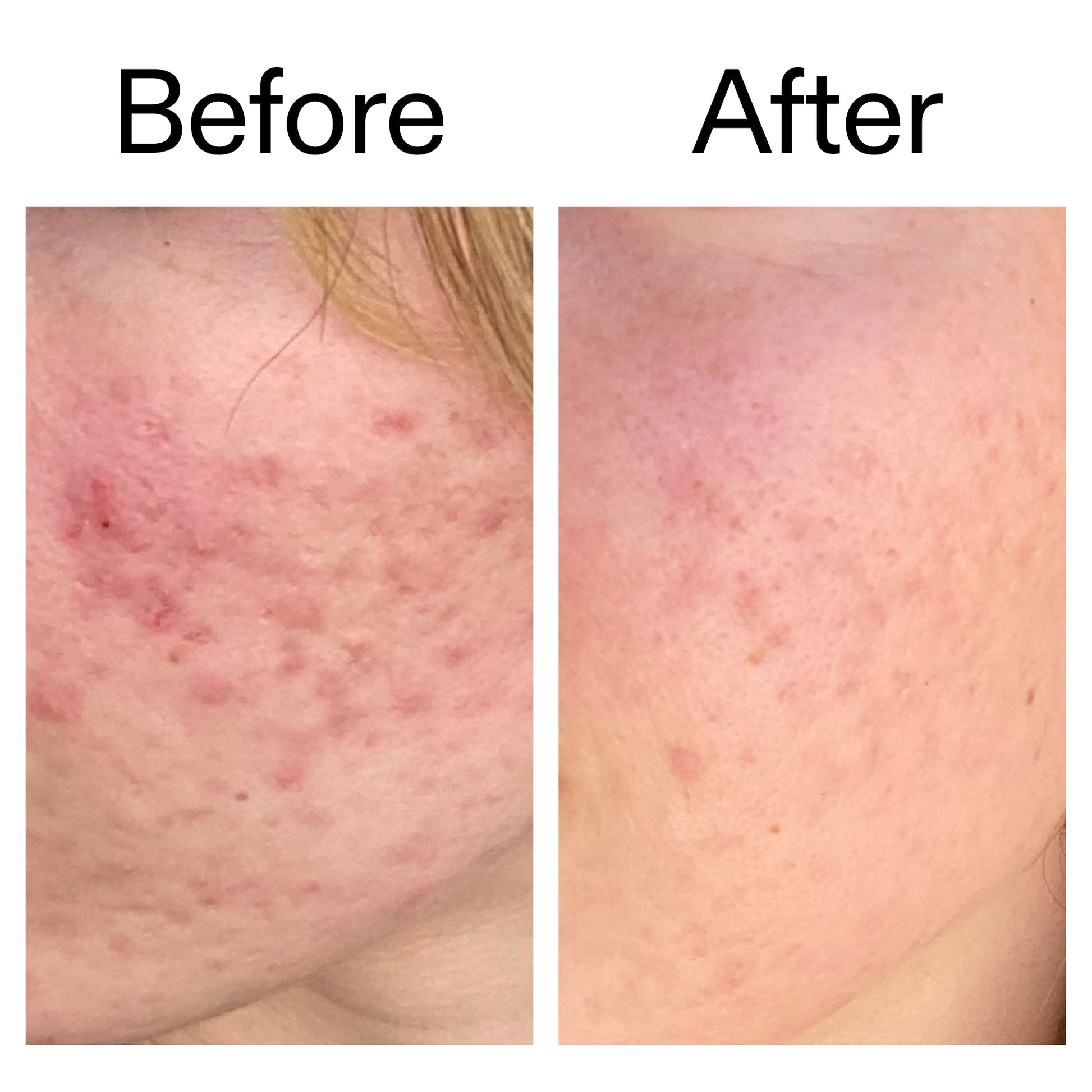 10-azelaic-acid-serum-for-redness-relief-j8 Azealic_Acid_Serum_B_A_Ppage_2000_x_2000.jpg