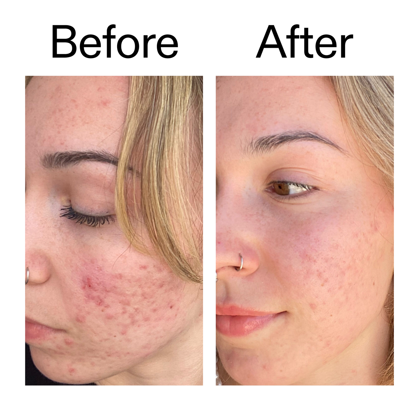 10-azelaic-acid-serum-for-redness-relief-j8 B_A_2_PPAGE.png