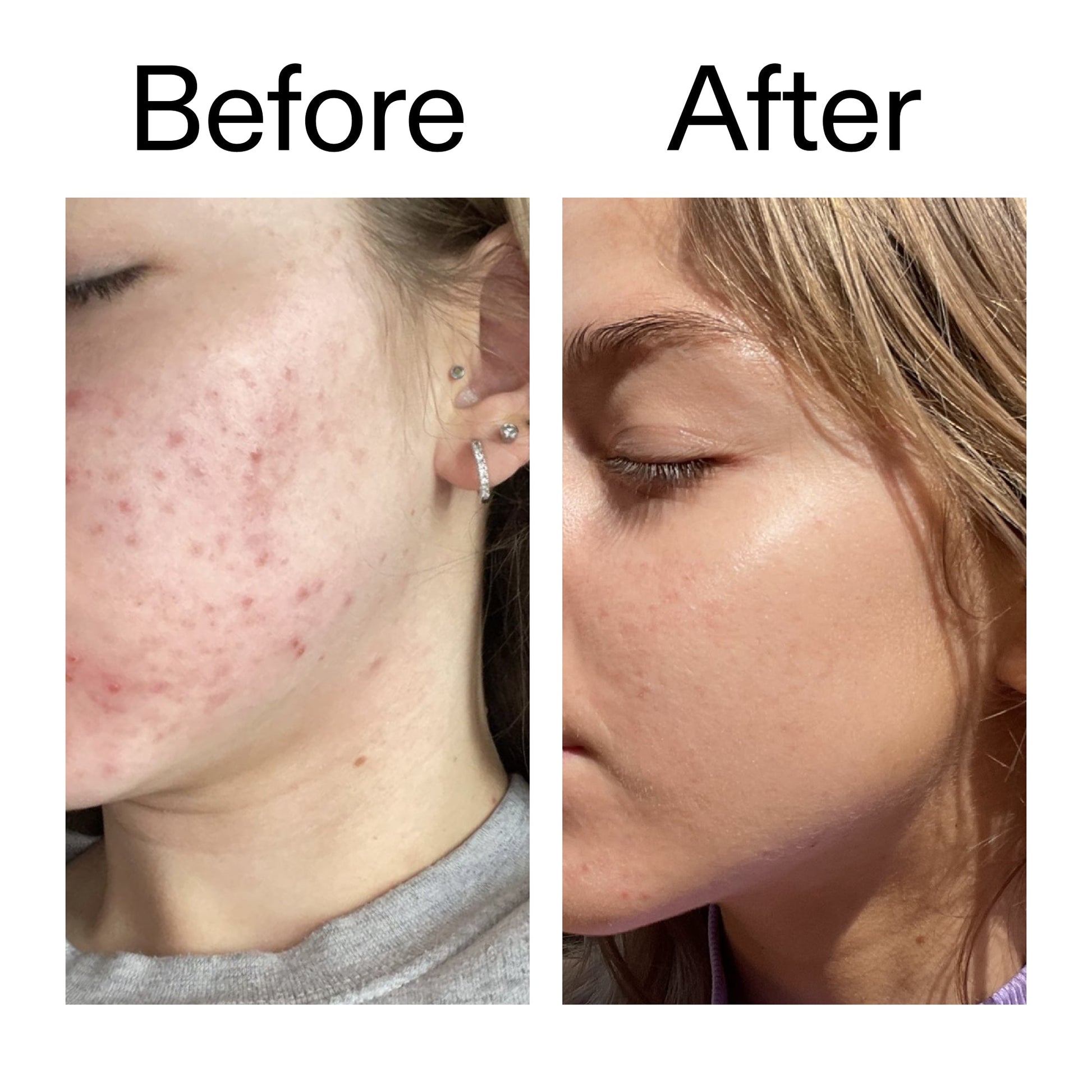 beta-hydroxy-acid-bha-serum-e4 Beta_Hydroxy_Acid_Serum_Before_After_2000x2000_96fda3e5-938d-49ef-bcf2-a0fa6ece4e2c.jpg