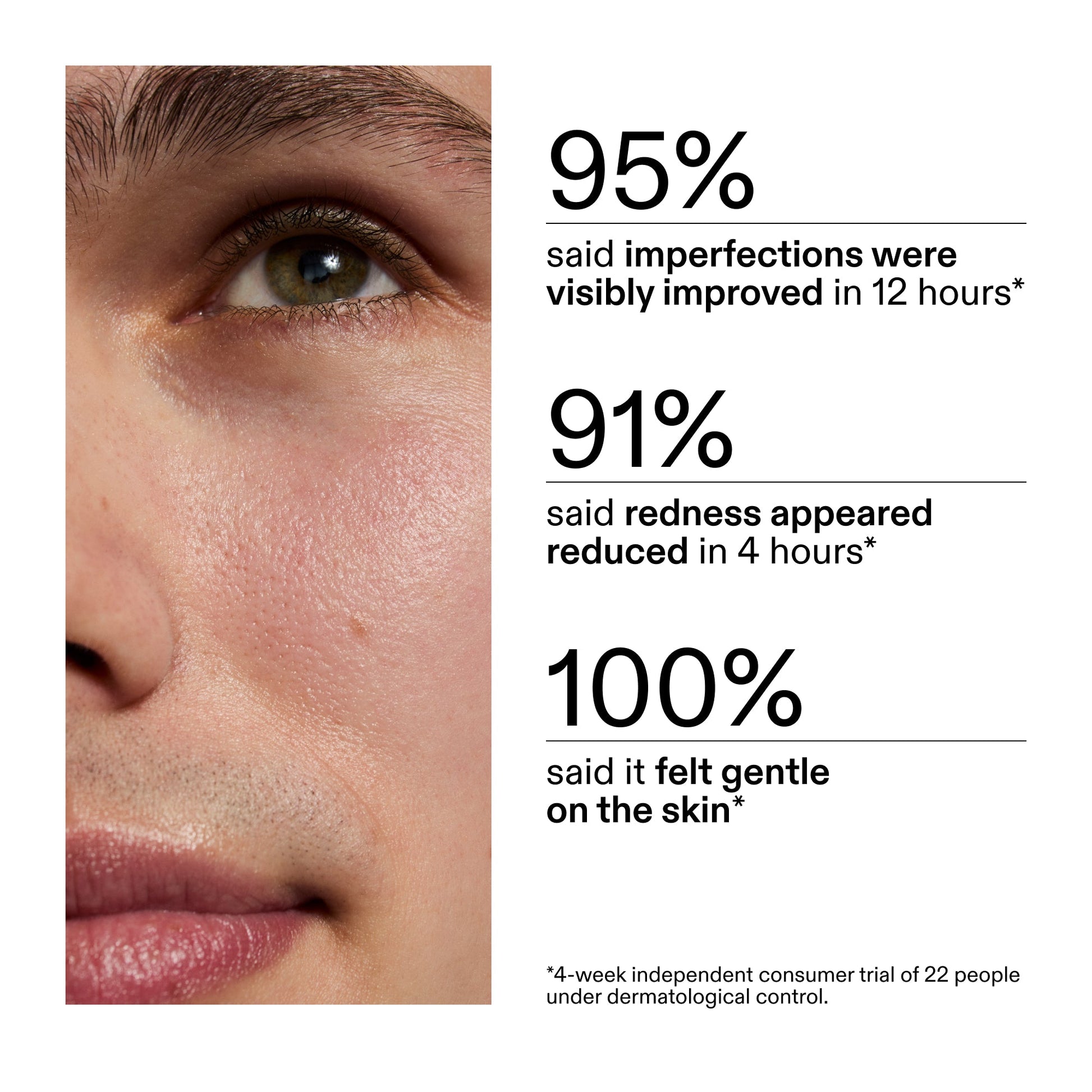 succinic-acid-acne-treatment-i3 CA_Succinic_Acid_Treatment_key_Claims_2000x2000_db91b0f1-7f29-4bfe-bb16-63a47f500960.jpg