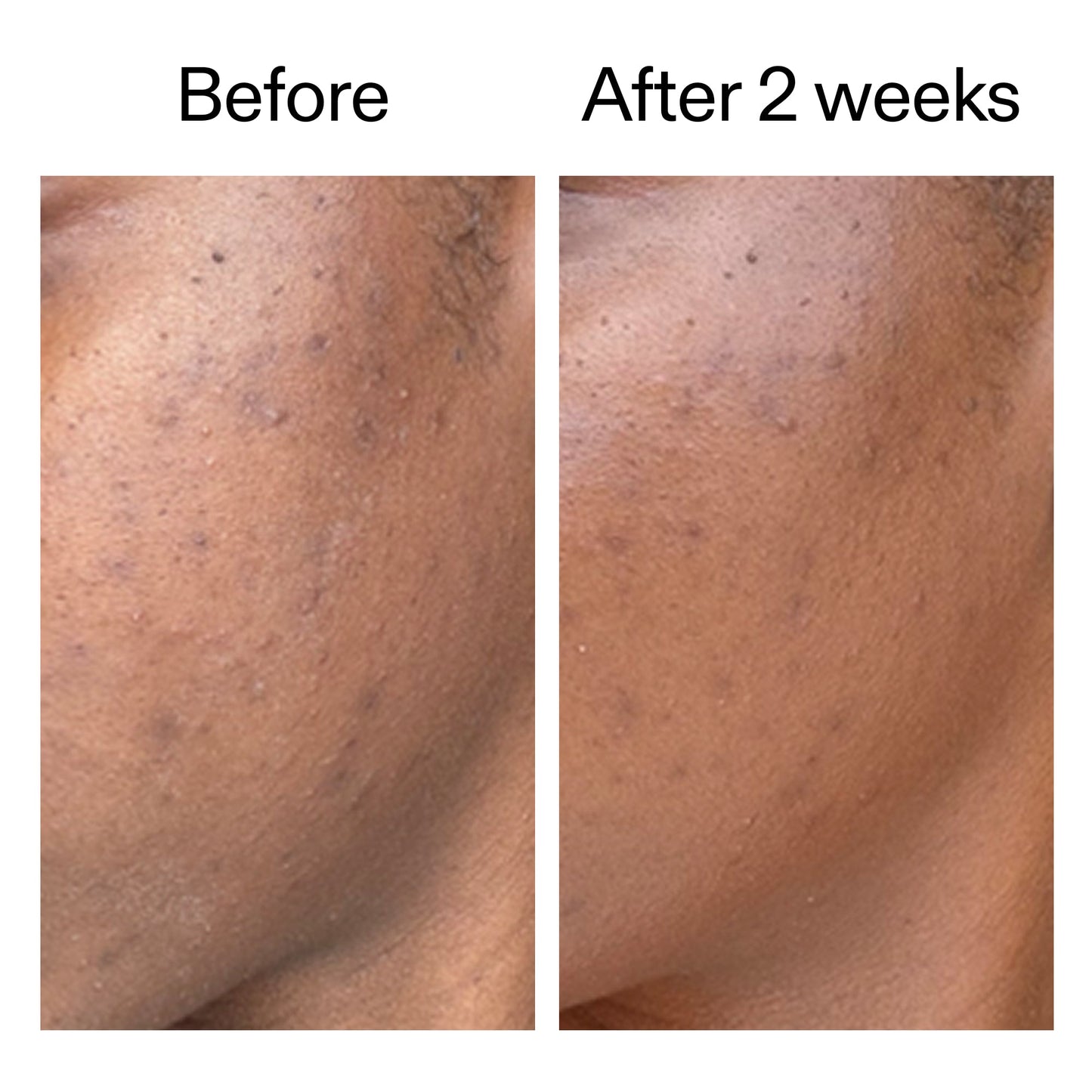 360-acne-clearing-duo-s5 DIOICB_A2000x2000.jpg