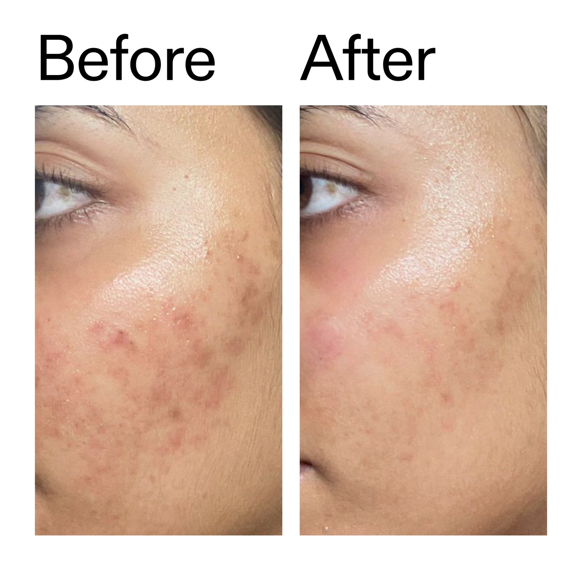 ectoin-hydro-barrier-serum-c4 Ectoin_Hydro-barrier_Serum__Before_After_2000x2000_34261920-d004-48d0-9c7b-8e1c15971bfd.jpg