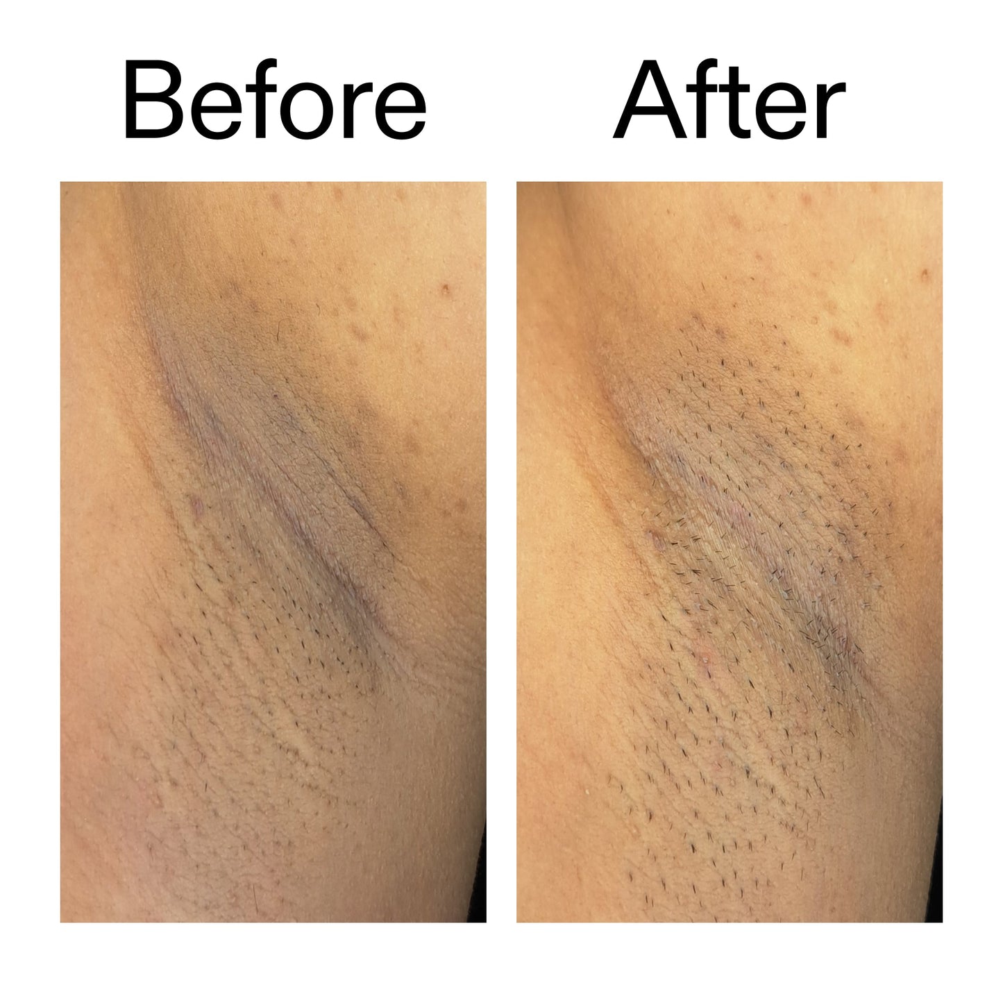 glycolic-acid-exfoliating-body-stick-duo-o8 Glycolic_Acid_Exfoliating_Body_Stick_Before_After_V3_2000x2000_ea919cd9-1439-4a46-82a0-76200eb5bb42.jpg