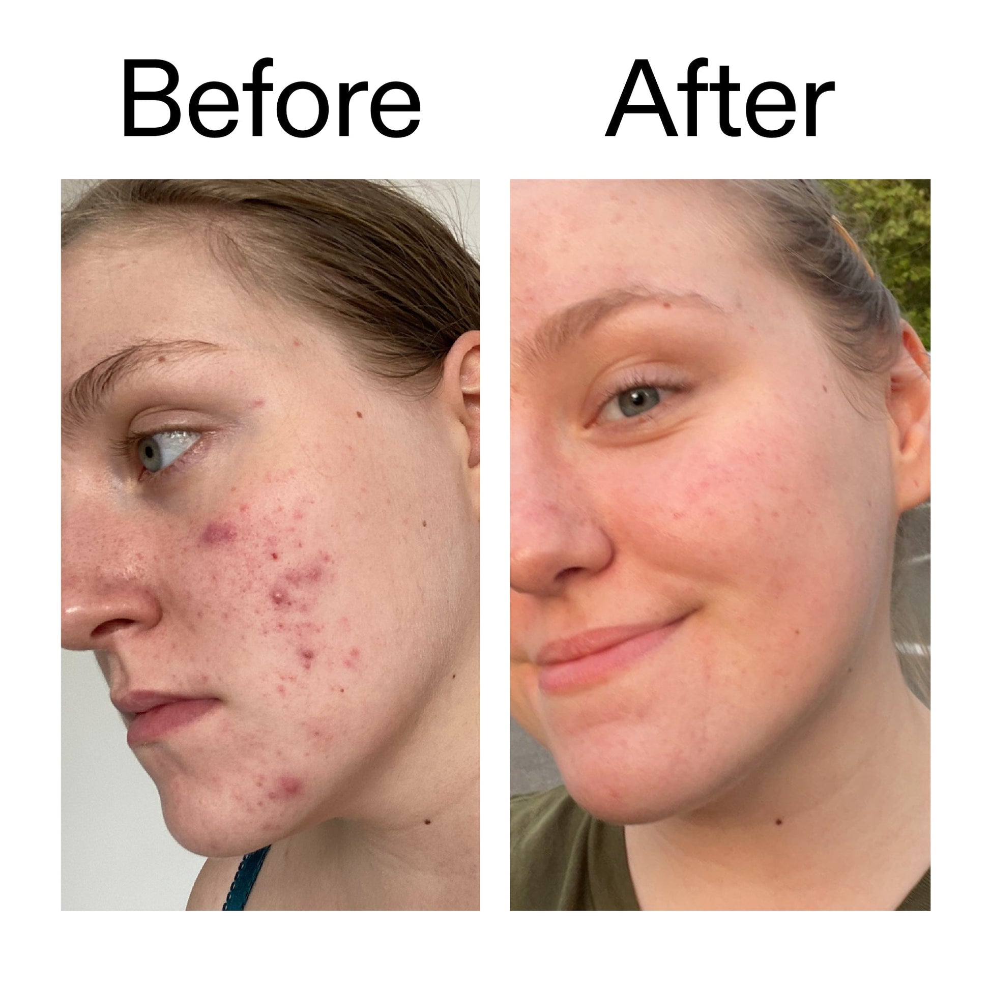 glycolic-acid-toner-p7 Glycolic_Acid_Toner_Before_After_2000x2000_49f0b9f7-e71b-4b2e-a8f8-2ea4b73247bb.jpg