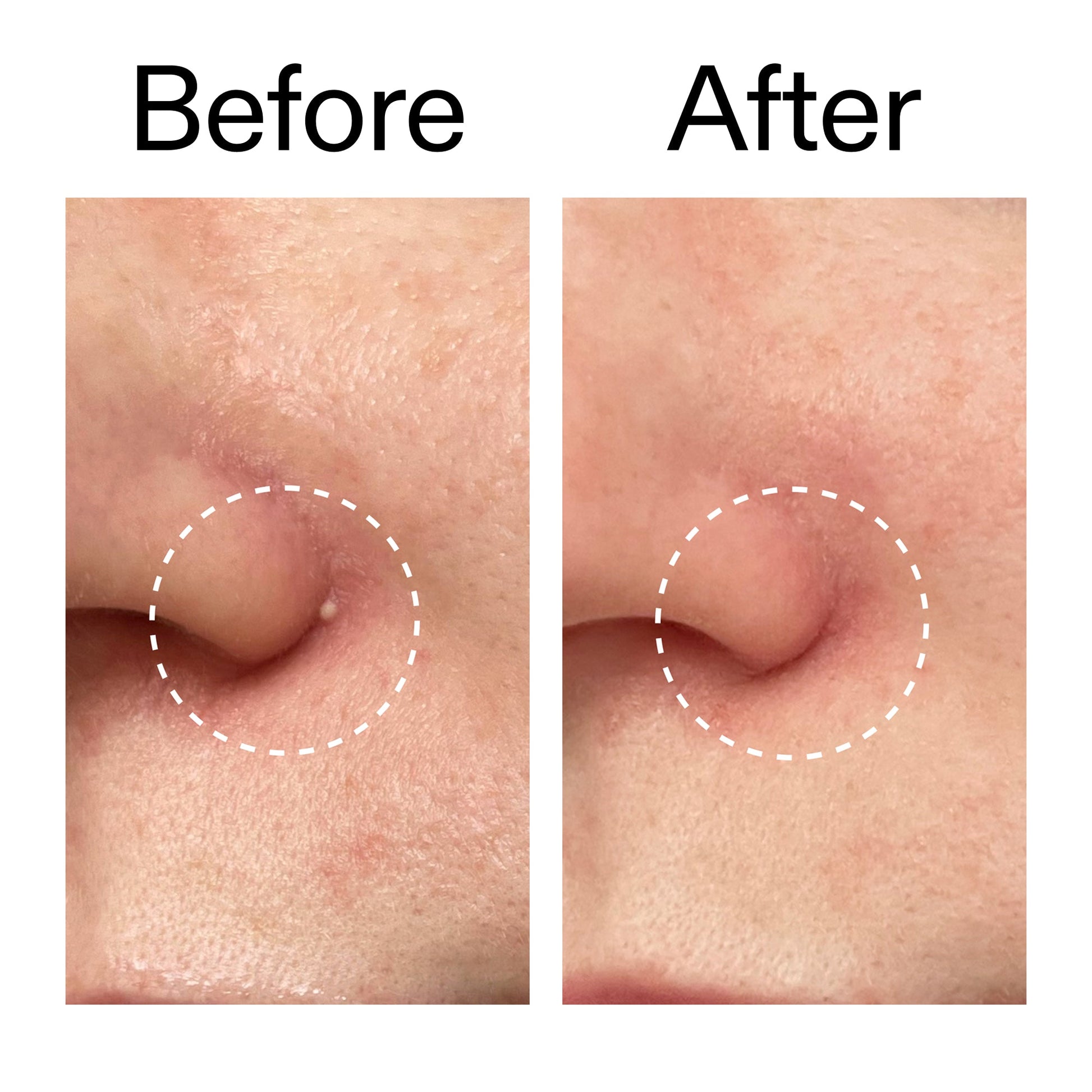 hydrocolloid-invisible-pimple-patches-pack-of-44-n4 Hydrocolloid_Invisible_Pimple_Patches_Before_After_2000x2000_b02aa37b-c78a-4682-91de-9135af5bb7df.jpg