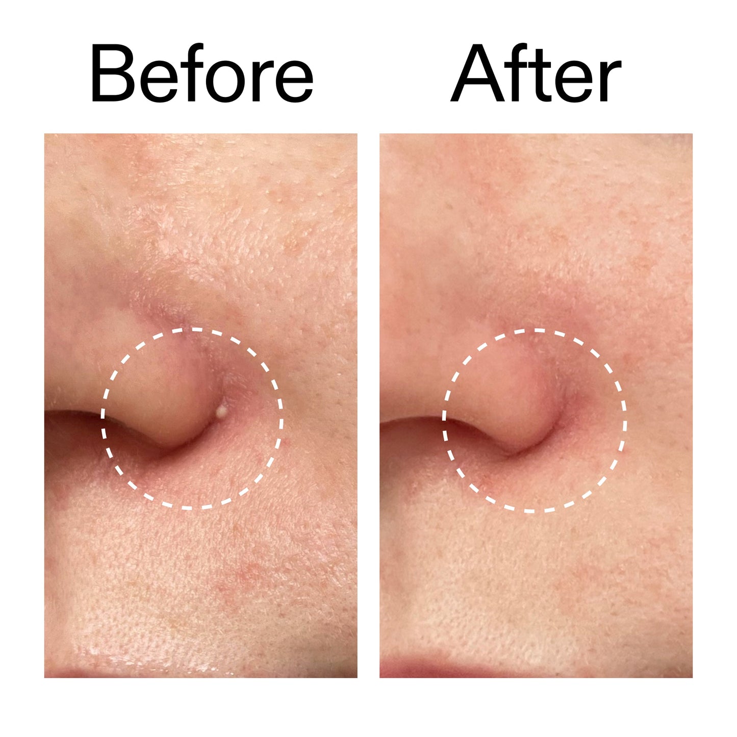 hydrocolloid-invisible-pimple-patches-pack-of-22-d0 Hydrocolloid_Invisible_Pimple_Patches_Before_After_2000x2000_b02aa37b-c78a-4682-91de-9135af5bb7df.jpg