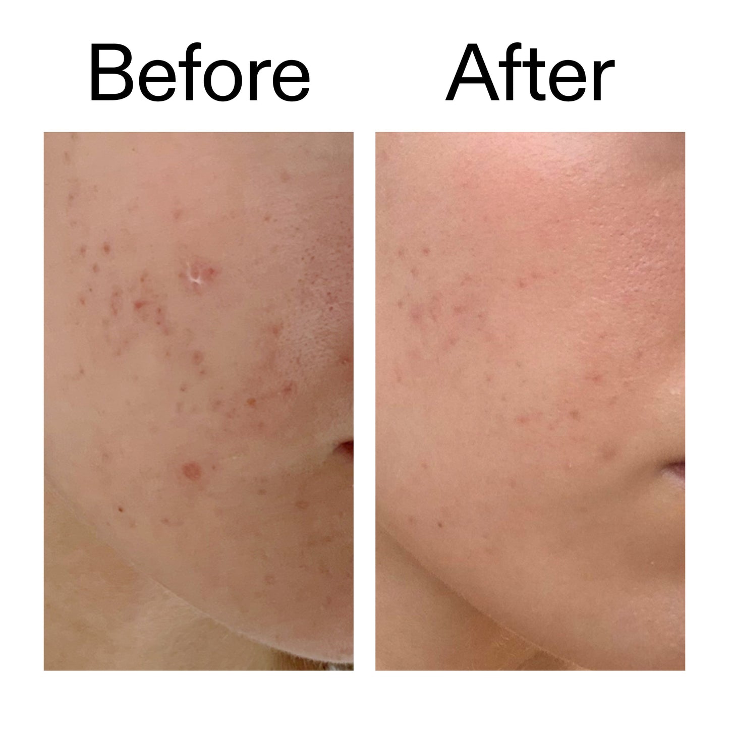 mandelic-acid-treatment-p6 Mandelic_Acid_Treatment_Before_After_2000x2000_4885ac6e-c5d7-4279-a72a-1417af7dce35.jpg