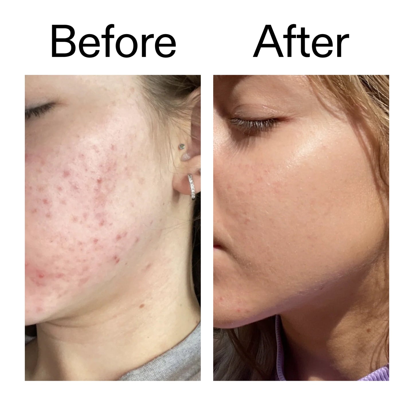 10-niacinamide-serum-a8 Niacinamide_Serum_Before_After_2000x2000_bde32455-9e7d-448e-b053-bef41504f0a9.jpg