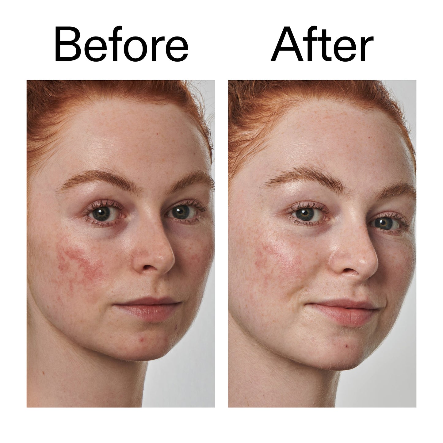 10-azelaic-acid-serum-for-redness-relief-j8 Redness_Relief_Serum_Before_After_2000x2000_3334dc9a-cce9-4e00-8aec-7ad89ca051f2.jpg