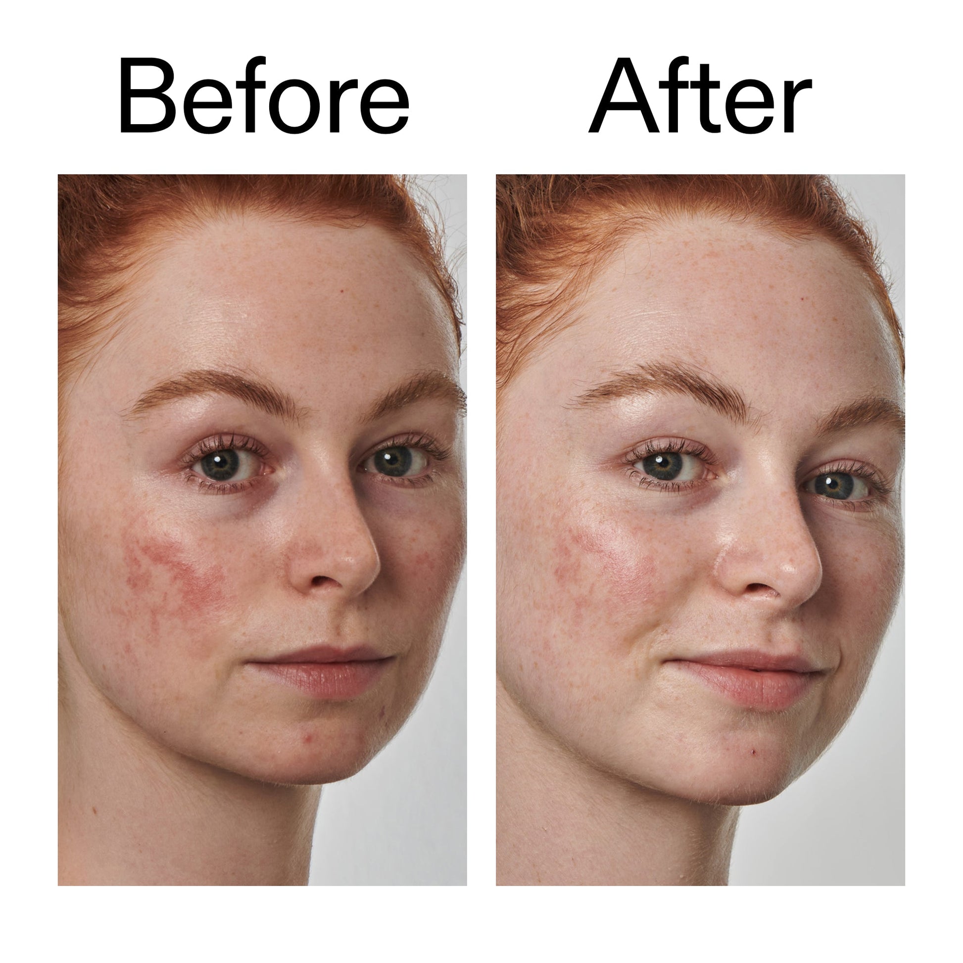 10-azelaic-acid-serum-for-redness-relief-j8 Redness_Relief_Serum_Before_After_2000x2000_3334dc9a-cce9-4e00-8aec-7ad89ca051f2.jpg