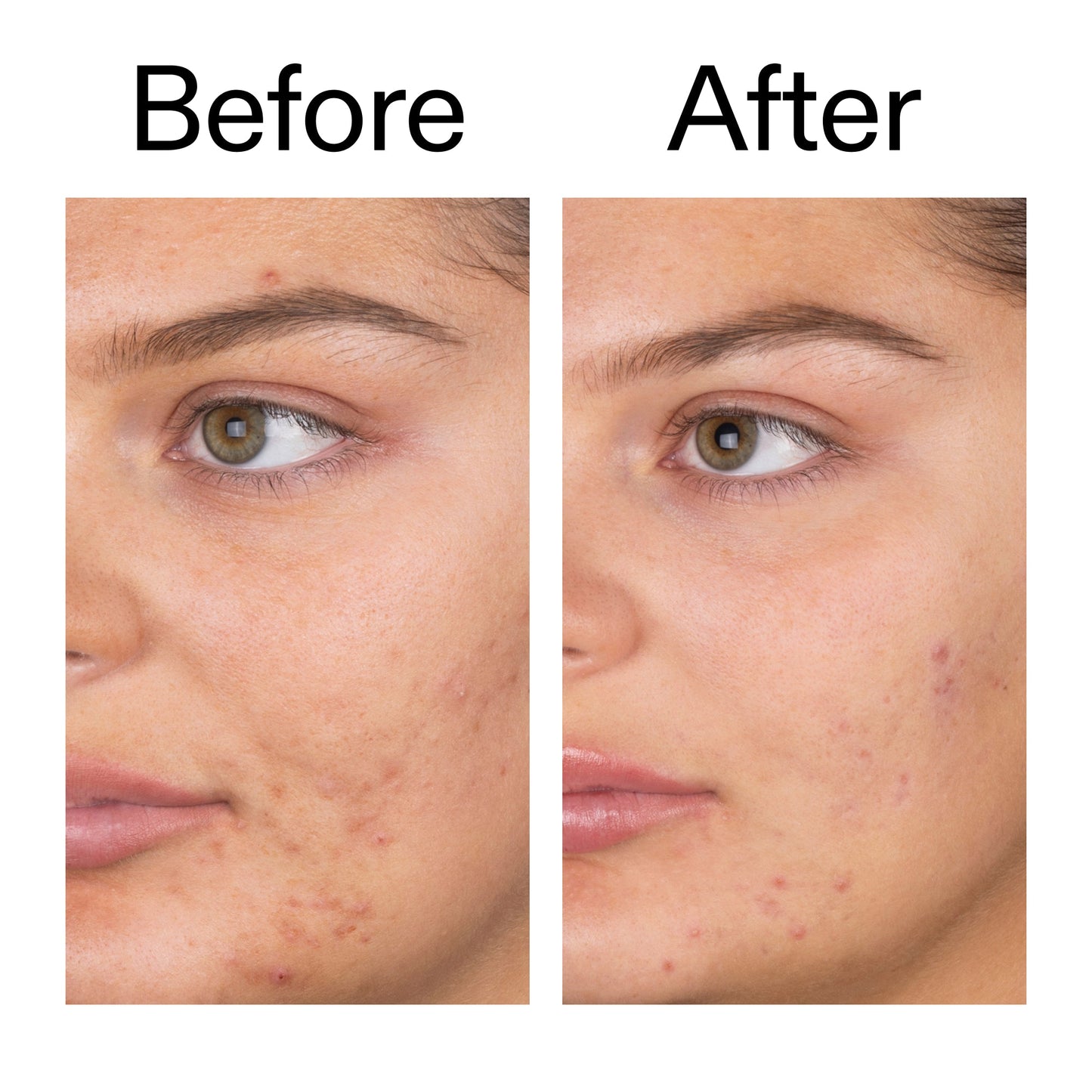 salicylic-acid-cleanser-150ml-k4 Salicylic_Acid_Cleanser_-_150ml_Before_After_2000x2000_e7230494-853f-4b07-82b1-27669104c995.jpg