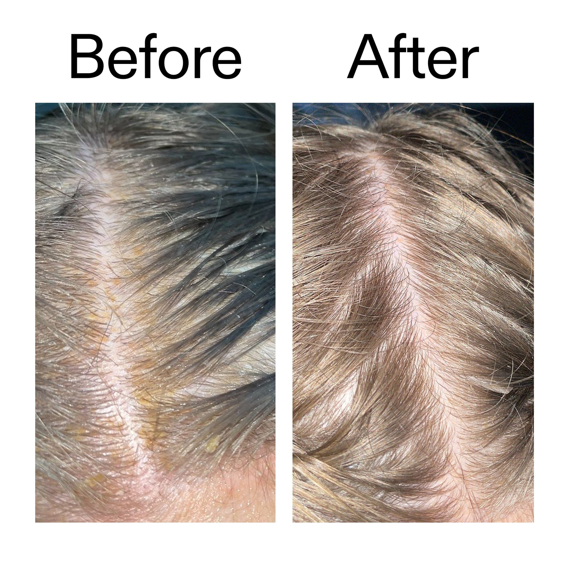salicylic-acid-exfoliating-scalp-treatment-b0 Salicylic_Acid_Exfoliating_Scalp_Treatment_Before_After_2000x2000_e572a30f-057c-4a48-823b-1c09dc97f8d0.jpg