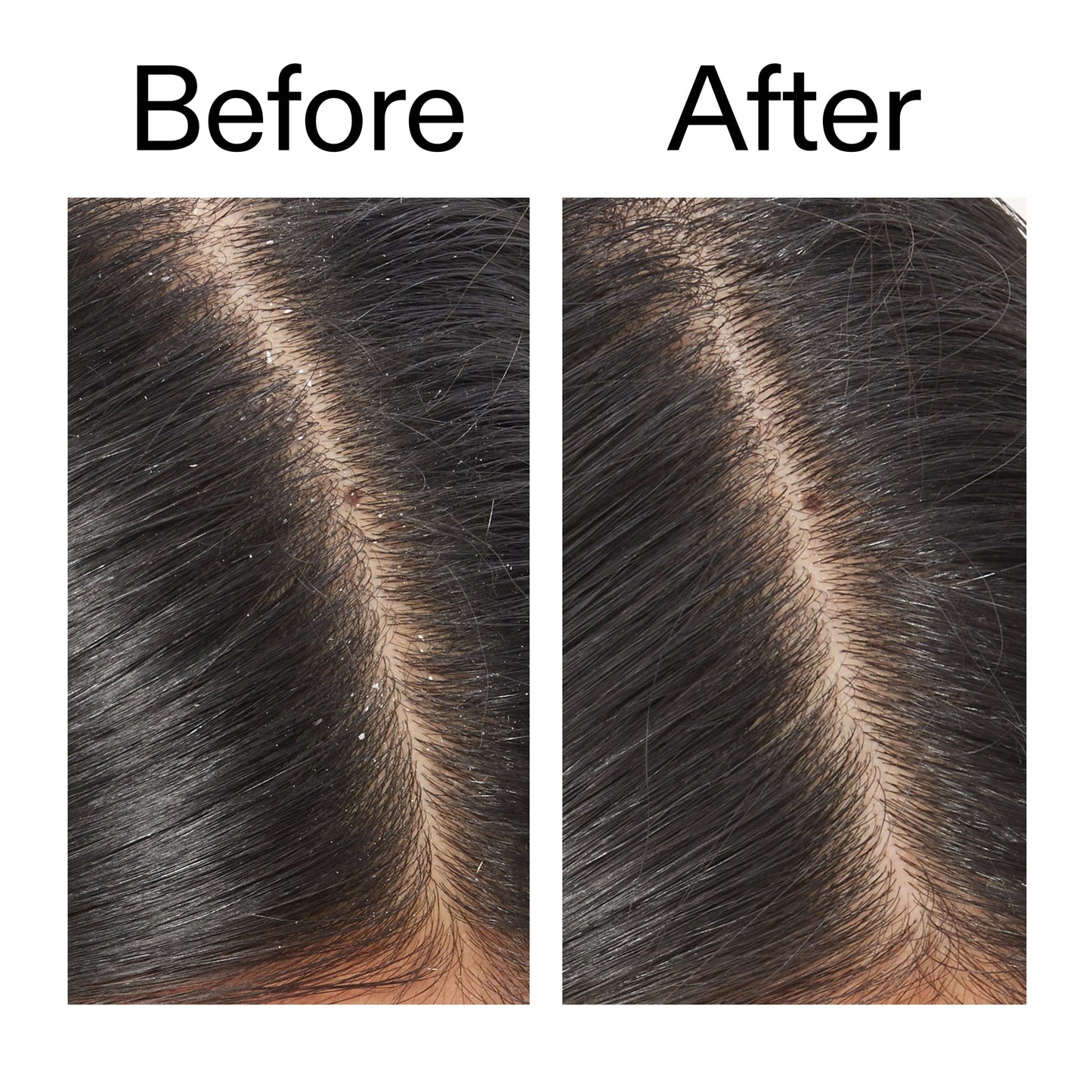 salicylic-acid-exfoliating-scalp-treatment-b0 Salicylic_Acid_Exfoliating_Scalp_Treatment_Before_After_V2_2000x2000_02bd61ad-42bf-490b-b3e3-7e04b2e8a673.jpg