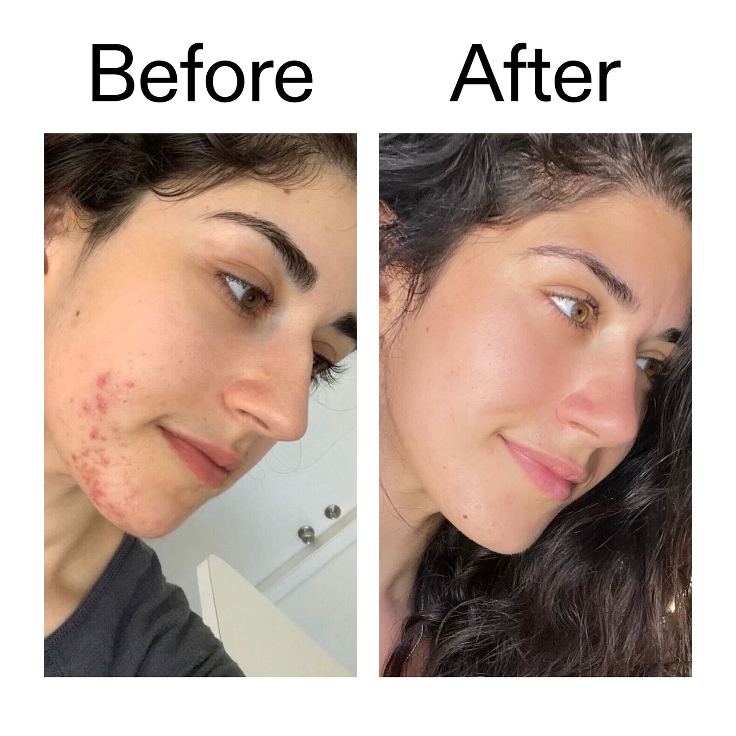 succinic-acid-acne-treatment-f9 Succinic_Acid_Treatment_Before_After_2000x2000_6a5f0054-2f58-4433-9314-0dc72c9bdd3b.jpg