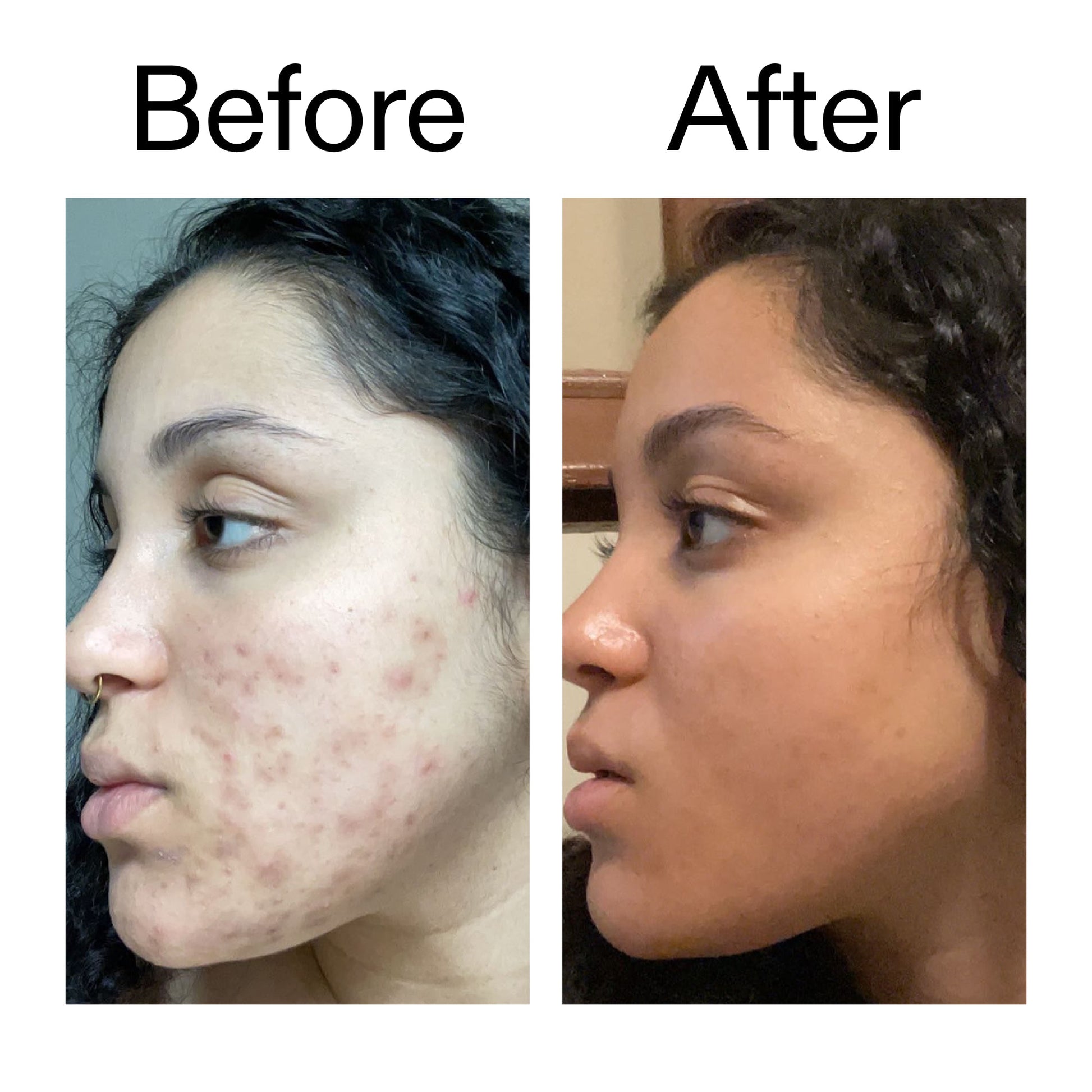 tranexamic-acid-serum-c8 Tranexamic_Acid_Serum_Before_After_2000x2000_98ebc8be-77b0-4843-8a22-90790ebe918b.jpg
